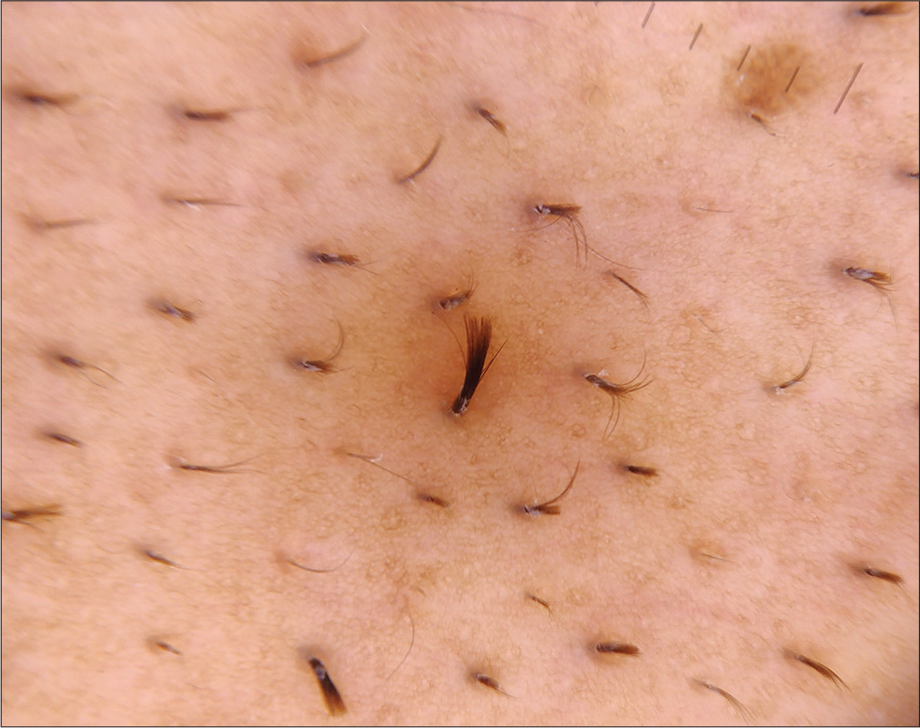 Trichoscopy (Illuco IDS-1100, Korea; ×10, polarized mode) revealing multiple short terminal hair emerging from a single hair canal