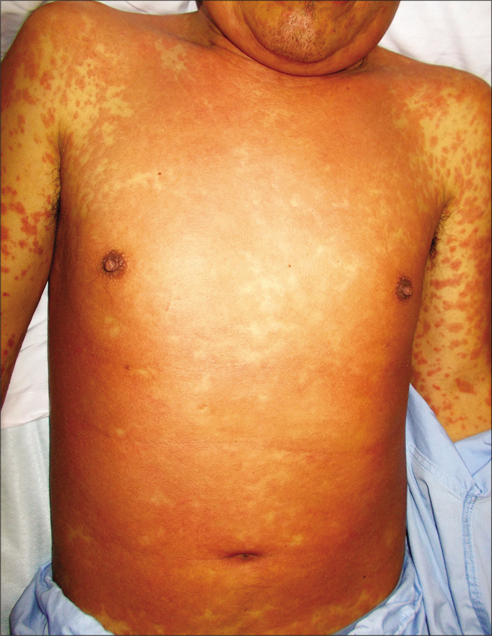 Síndrome de DRESS (Drug Reaction with Eosinophilia and Systemic