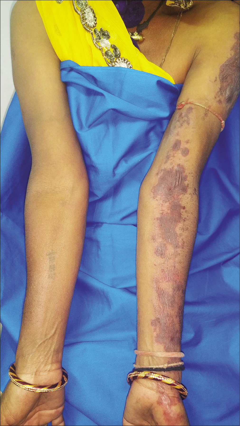 Multiple well-defined hemorrhagic bullae and dusky erythematous to brownish discoloration over left shoulder, upper arm and hand