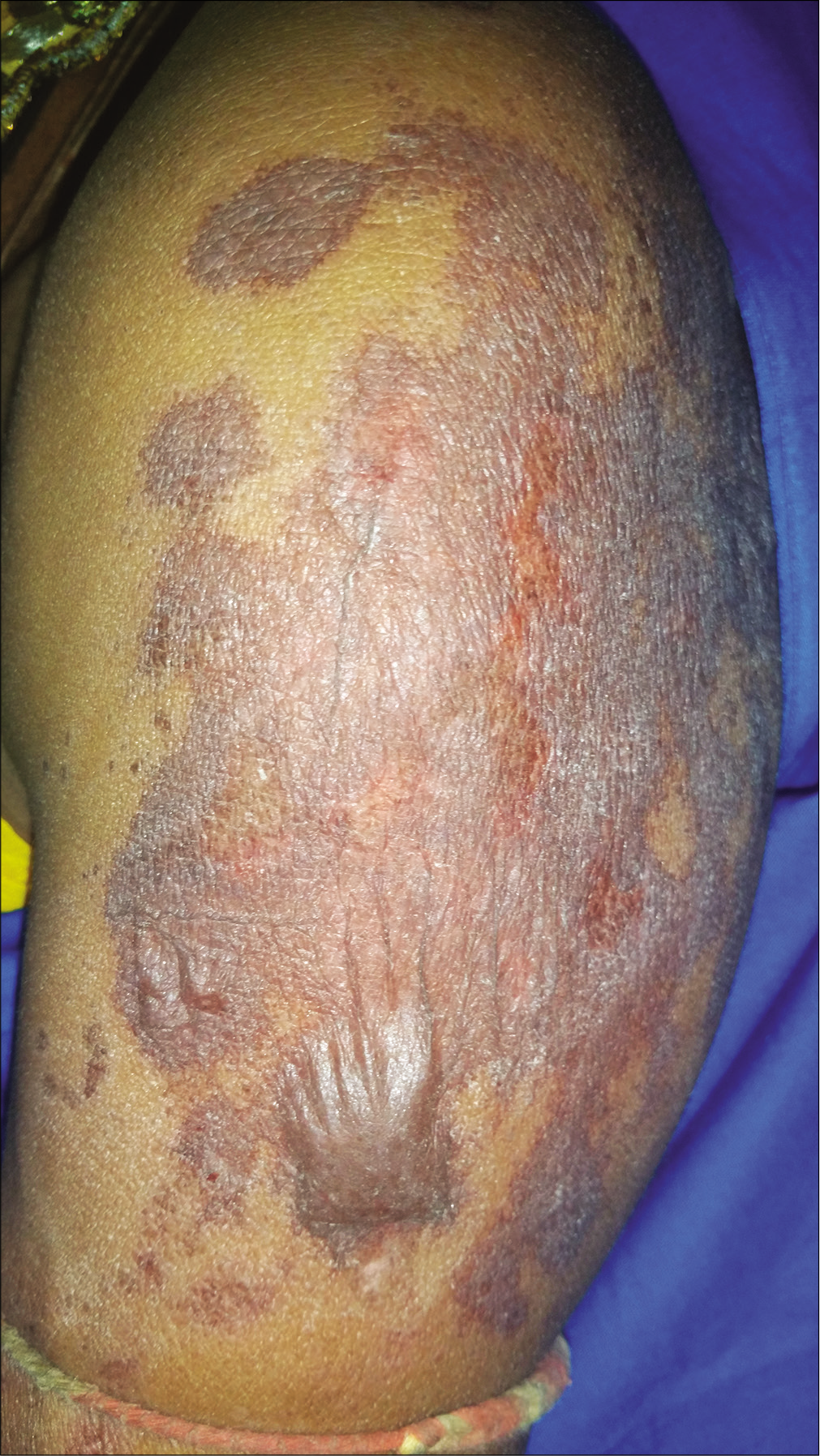 A close-up view of left arm showing lesions of bullous fixed drug eruption