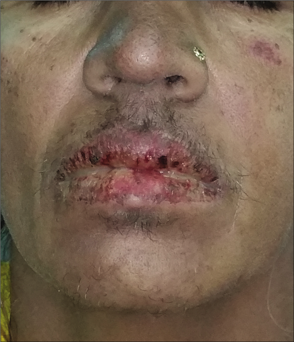 Hemorrhagic crusting over lips