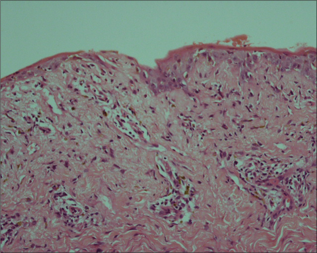 Focal basal vacuolation with denudation of superficial layers of epidermis, upper dermal mononuclear inflammatory infiltrate and dermal melanophages (H and E, ×20)