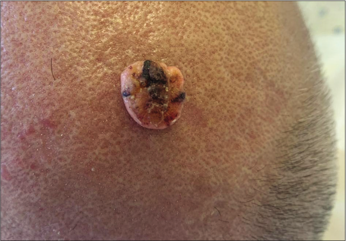 A skin-colored to yellowish firm nodule with central hyperkeratosis located on the anterior scalp