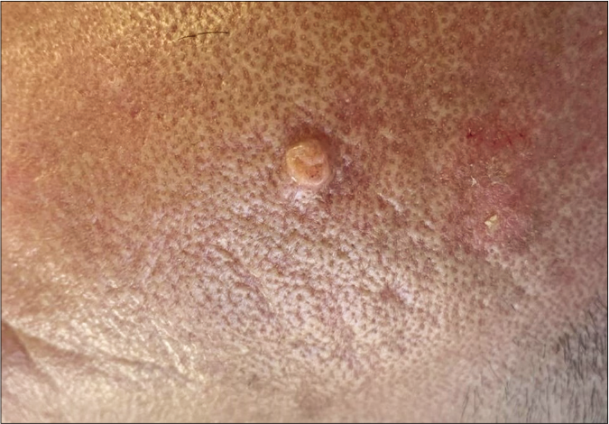 A skin-colored papule with an elevated border and central depression