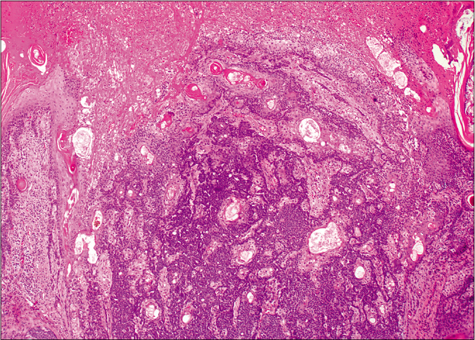 Basaloid germ cells (80%) admixed with mature sebocytes (20%). The top of the lesion shows mounds of parakeratosis and hemorrhage (H and E,×20)