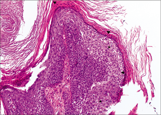 Papillary configurations lined by squamous cells with koilocytic changes (star) and hypergranulosis (arrow) with overlying parakeratosis (arrowhead) (H and E,×10)