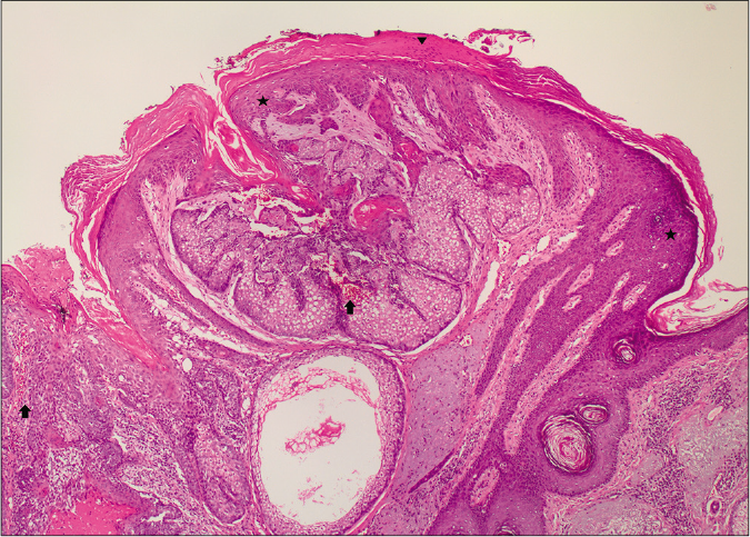 A well-circumscribed lesioncomposed of mature sebocytesand a few germ cells.The epidermis shows mounds of parakeratosis (arrowhead), hemorrhage (arrow) and koilocytes (star) (H and E,×20)