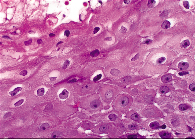 Koilocytic cells with enlarged pyknotic, wrinkled nuclei with a surrounding halo (H and E,×40)