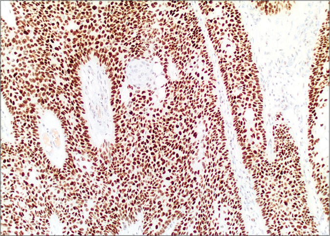 Diffuse nuclear labelling by androgen receptor antibody (×10)