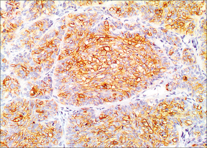 Membranous and cytoplasmic staining by epithelial membrane antigen (×20)