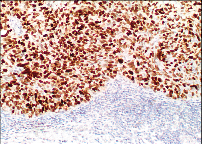 Diffuse nuclear labelling by androgen receptor antibody (×20)