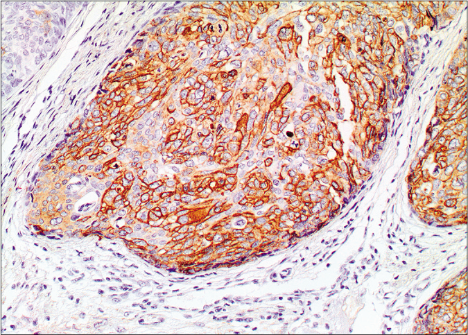 Membranous and cytoplasmic staining by epithelial membrane antigen (×20)