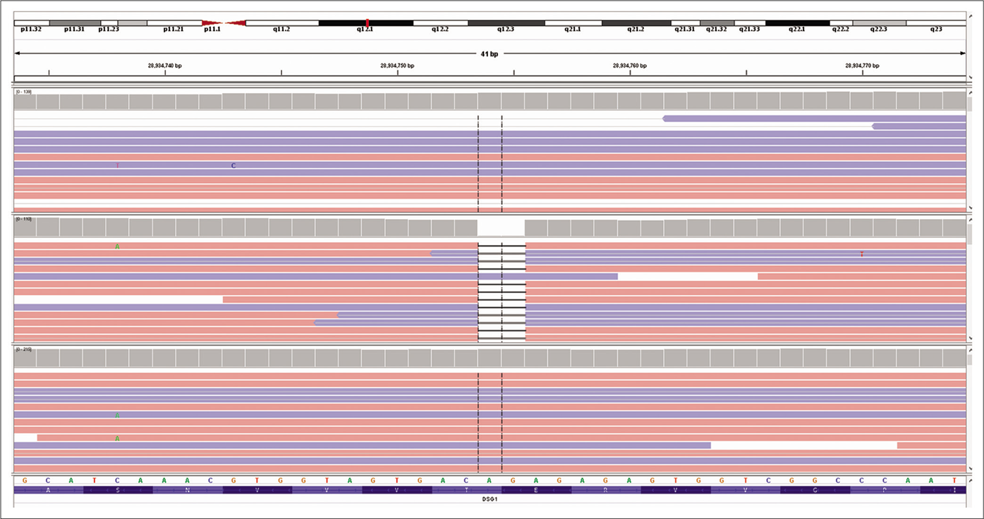 Excerpt of next-generation sequencing data of the proband visualized with the integrative genomic viewer showing homozygous 2 base pair deletion in exon 15 of desmoglein1 gene located on chromosome 18 compared with two control sequences