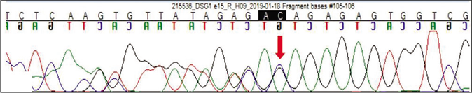 Sequence chromatogram and alignment to the reference sequence showing the identical variation in heterozygous carrier father indicated by the red arrow