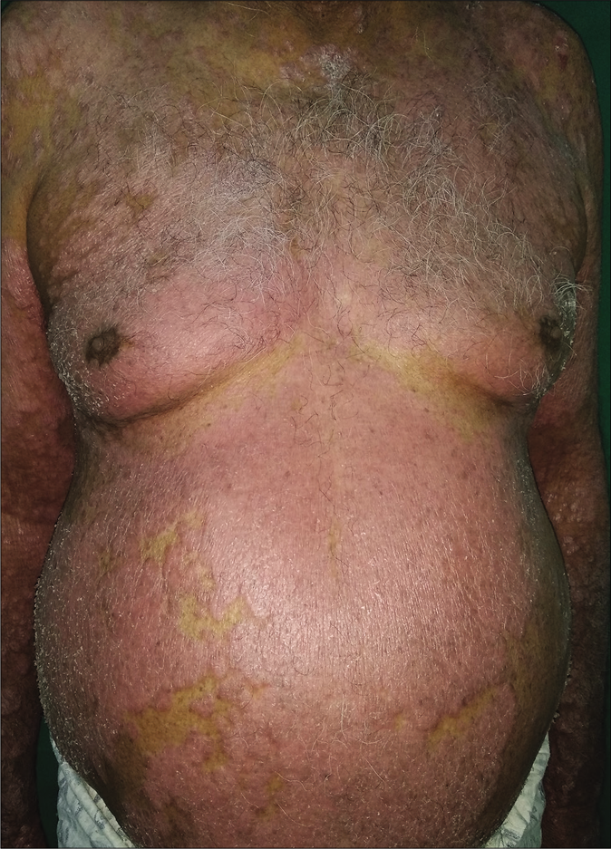 Involvement of trunk with erythematous, scaly plaques