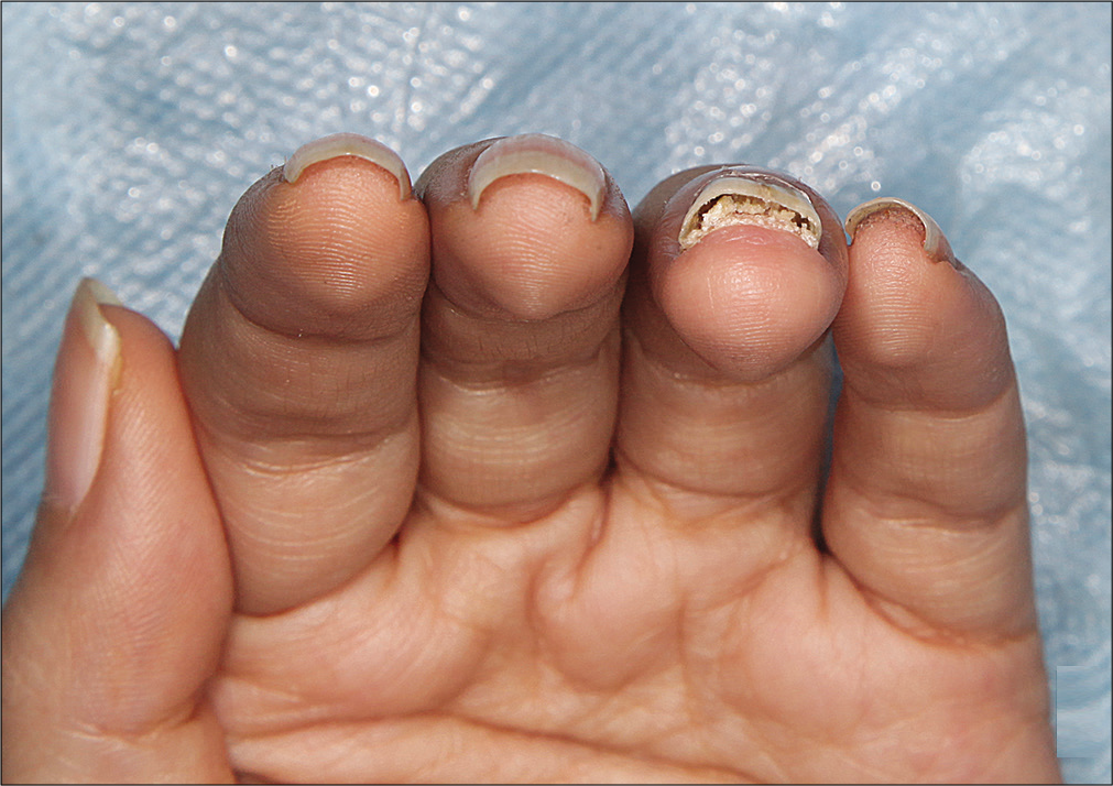 Subungual hyperkeratosis and onycholysis of left fourth finger