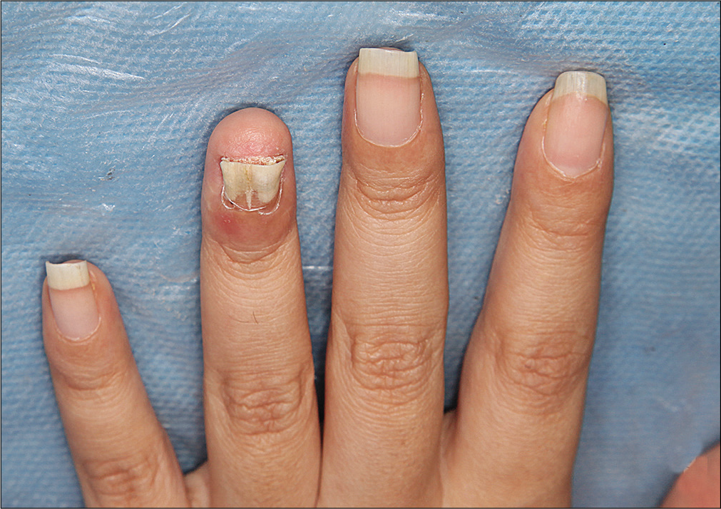 Paronychia and erythema of distal phalanx of left fourth finger