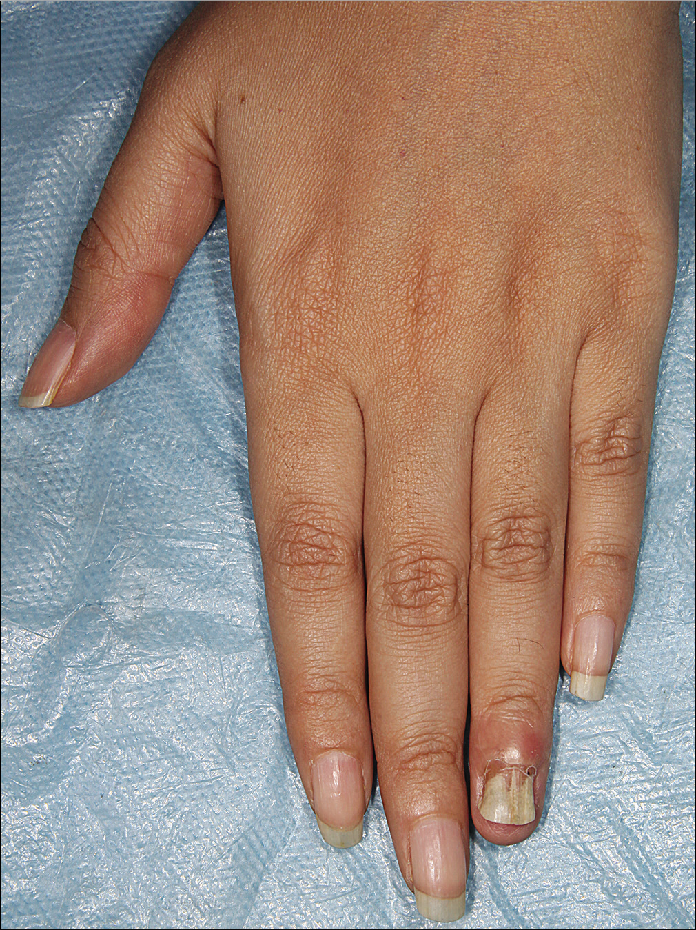 Swelling of distal phalanx of left fourth finger