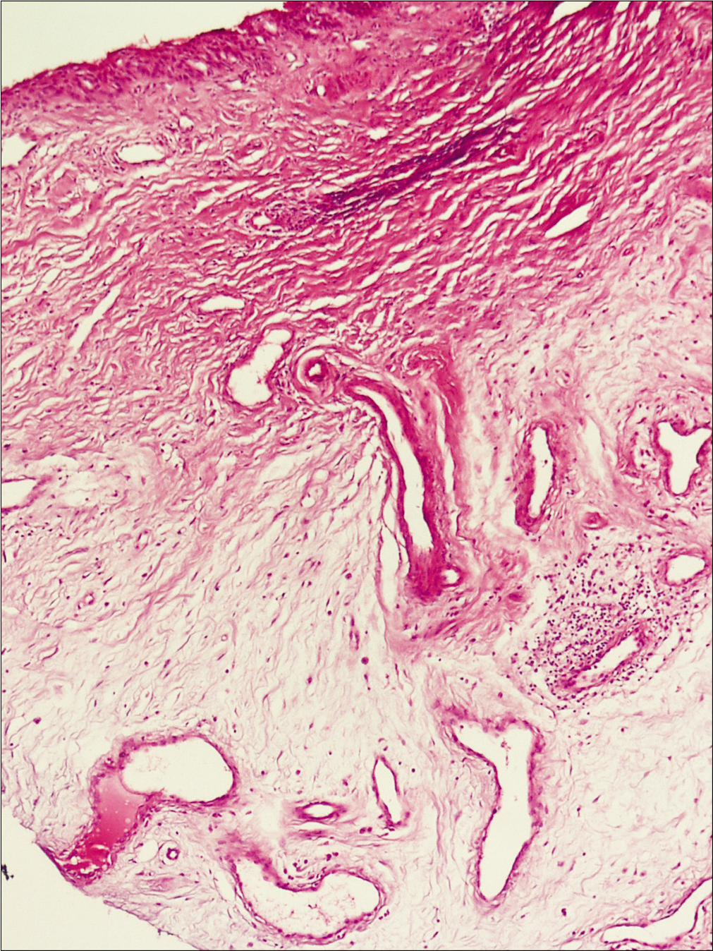 Increased thin-walled vessels in fibromyxoid stroma with mild spindle cell proliferation. Some mononuclear infiltrate in deep dermis (H and E, ×100)