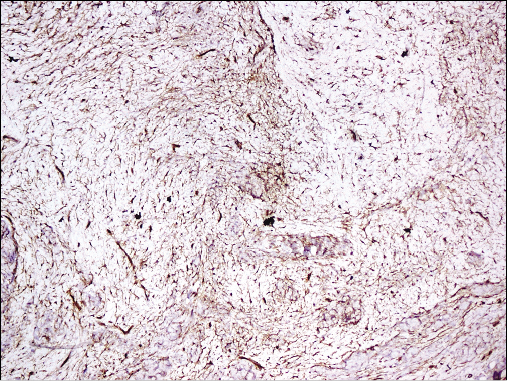 Tumor cells positive for CD34 (×100)