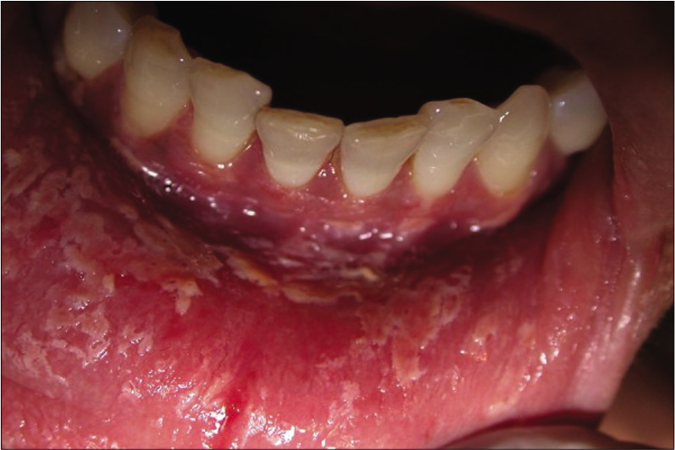 Desquamative gingivitis in a female patient with pemphigus vulgaris