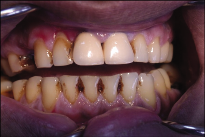 Desquamative gingivitis in a female patient with lichen planus