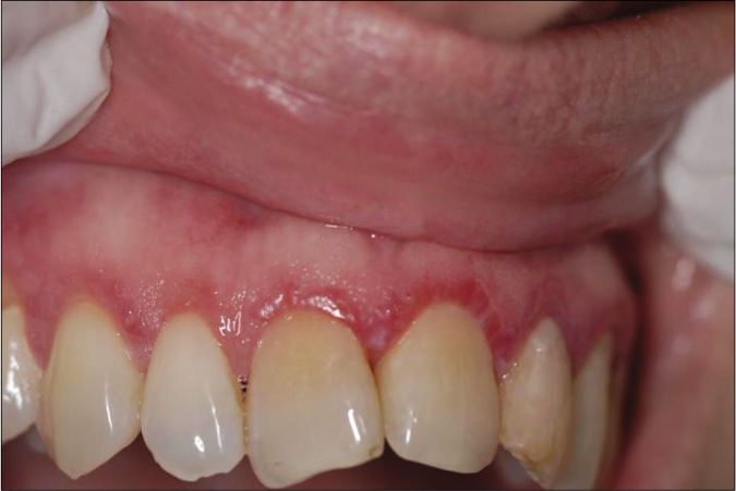 Desquamative gingivitis as an early presenting feature of mucous membrane pemphigoid