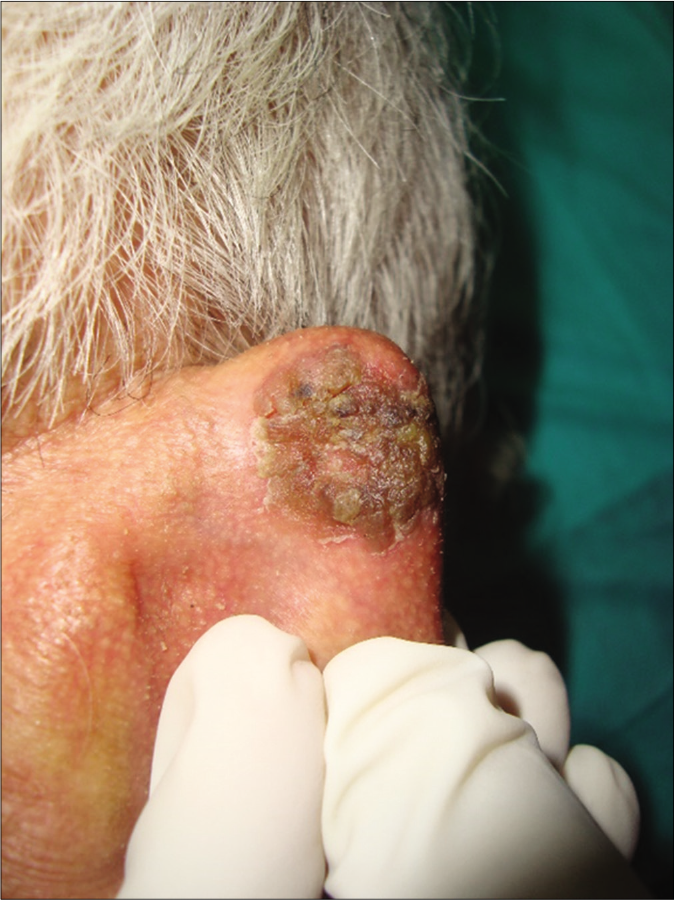 Patient 1, nodular basal cell carcinoma on the posterior aspect of ear helix: (1.5 cm × 2 cm)