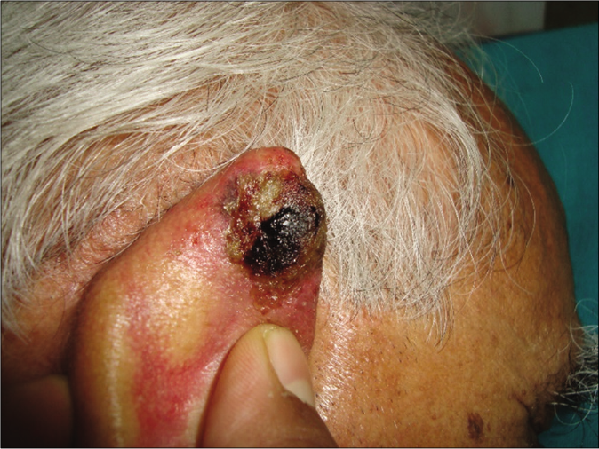 Patient 1, nodular basal cell carcinoma on the posterior aspect of ear helix: Inflamed plaque after 12 weeks of imiquimod 5% cream application for 3 days/week