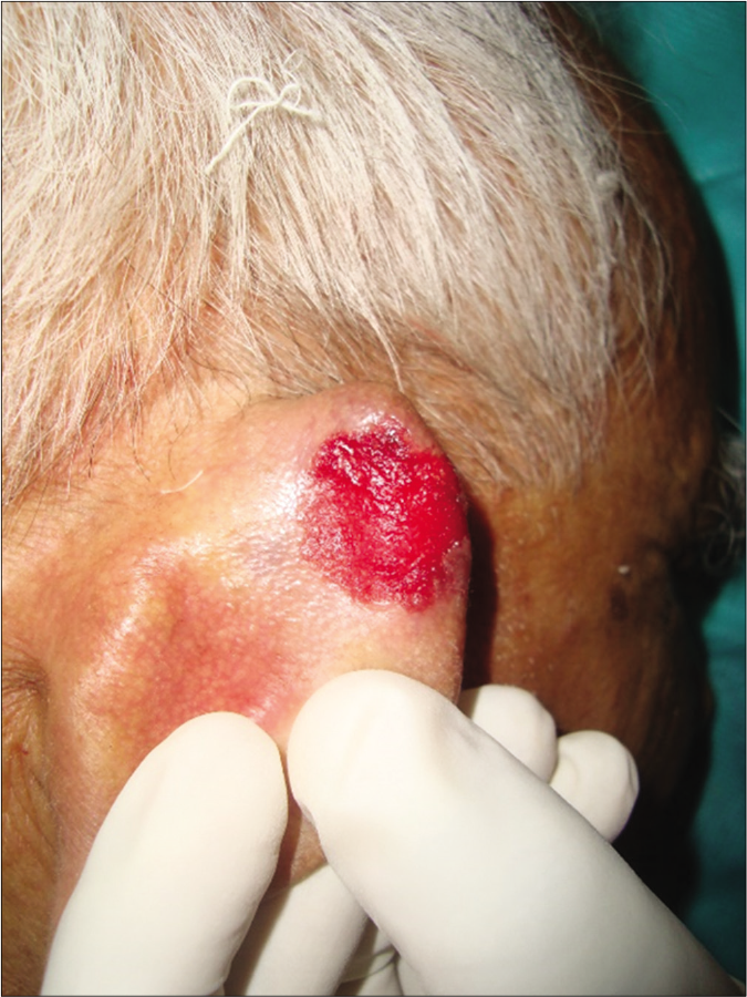 Patient 1, nodular basal cell carcinoma on posterior aspect of ear helix: Erythematous areas after curettage till deep dermis