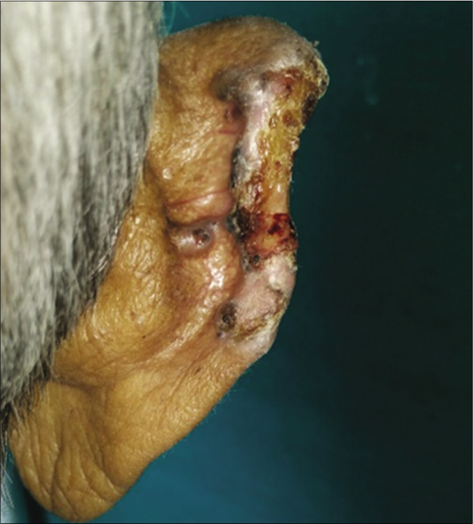 Patient 2, noduloulcerative basal cell carcinoma on the rim of the ear: (2.5 cm × 1 cm)