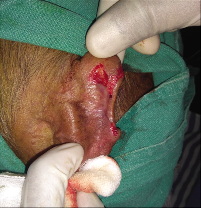 Patient 2, noduloulcerative basal cell carcinoma on the rim of ear: Erythematous areas after curettage till deep dermis