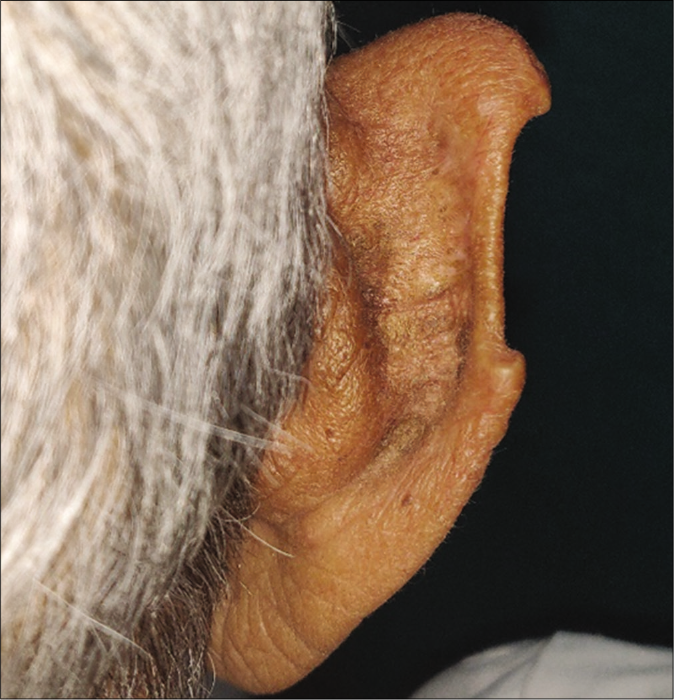 Patient 2, noduloulcerative basal cell carcinoma on the rim of ear: Wound healed without scarring/dyspigmentation at 20 months follow up