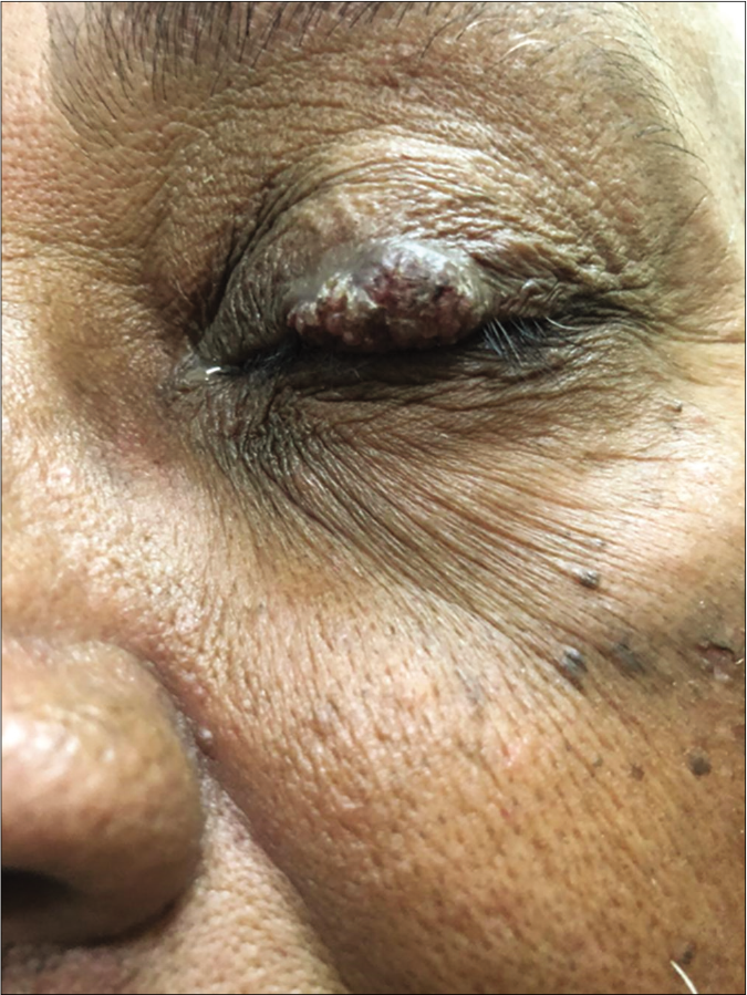 inverted follicular keratosis