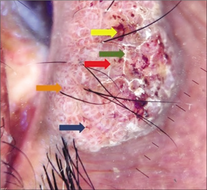 Dermoscopy (DermLite DL3N with iPhone X attachment at 10×, polarized mode) showed linear vessels with whitish halo (blue arrow), yellow white structureless areas (red arrow), red dots (yellow arrow), white lines (green arrow) and glomerular vessels (orange arrow)