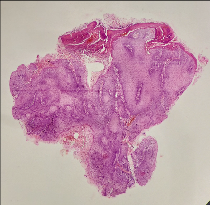 Scanner view shows an endo-exophytic growth with features of hyperkeratosis, acanthosis and inverted papillomatosis (H and E stain, 4×)