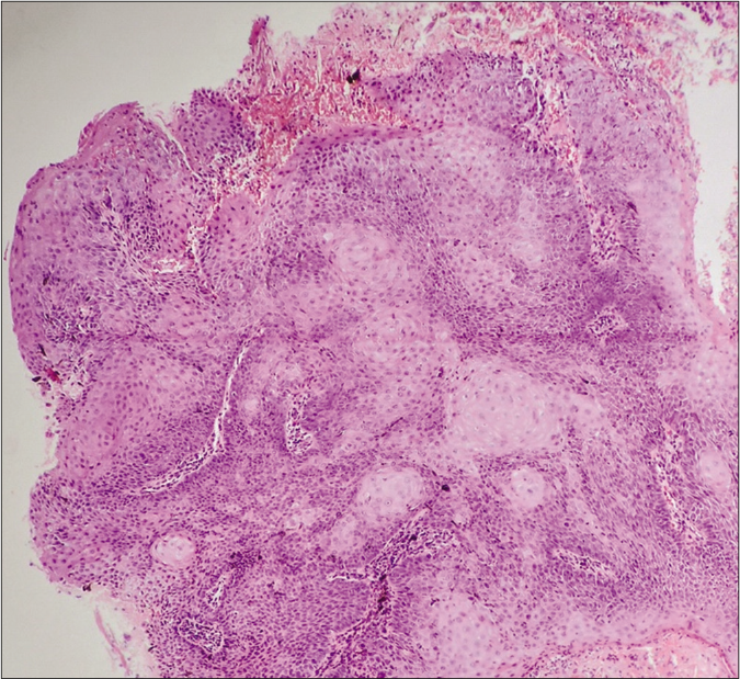 Numerous squamous eddies are visible (H and E stain 10×)