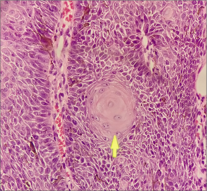 inverted follicular keratosis