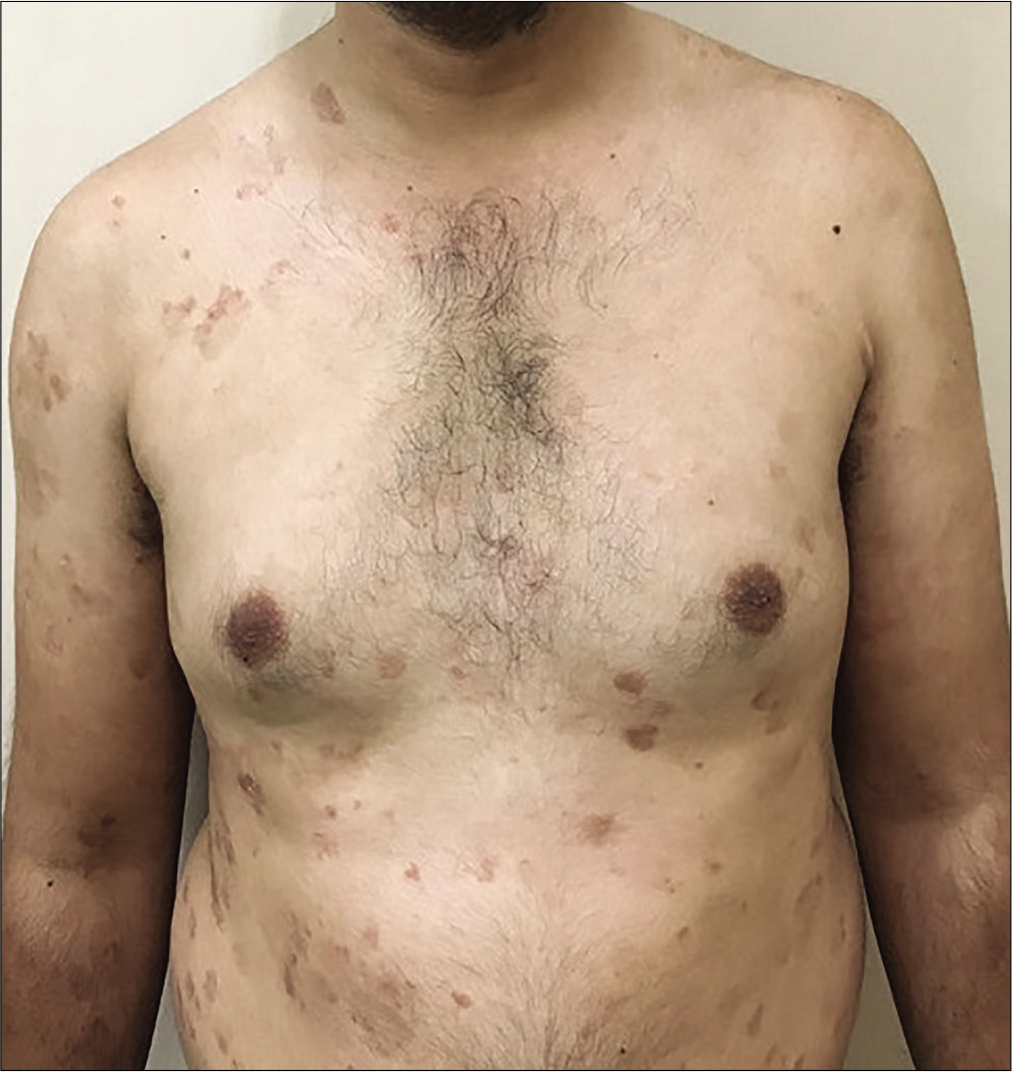 Same patient showing reduction in psoriasis area severity index to 4.8 at 3rd follow-up visit