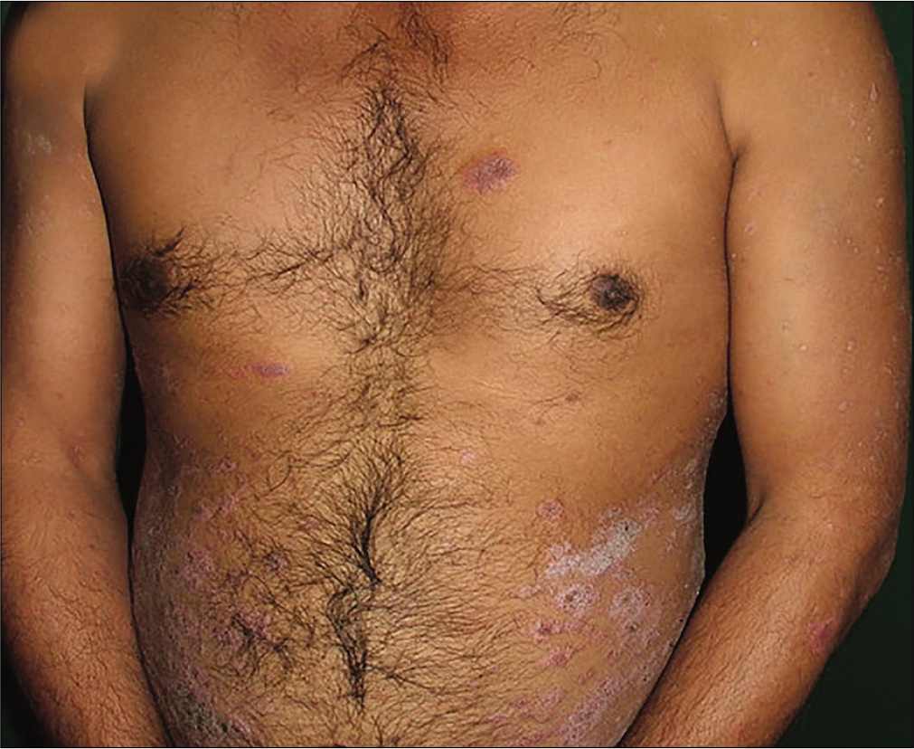 Patient receiving weekly 15 mg methotrexate with psoriasis area severity index 17.4 at baseline