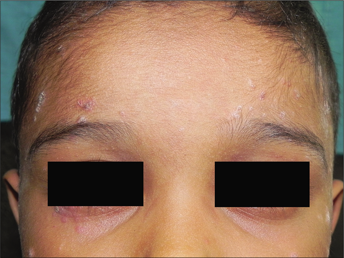 Centrofacial involvement in a child with guttate lesions on the forehead and cheeks