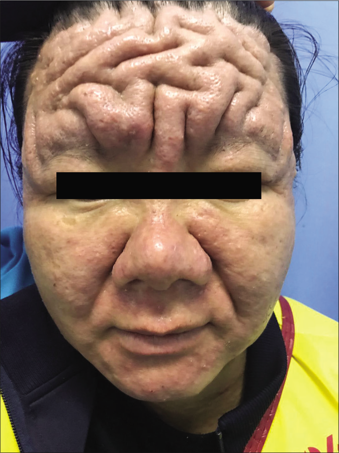 Cutis Verticis Gyrata Surgery Before And After