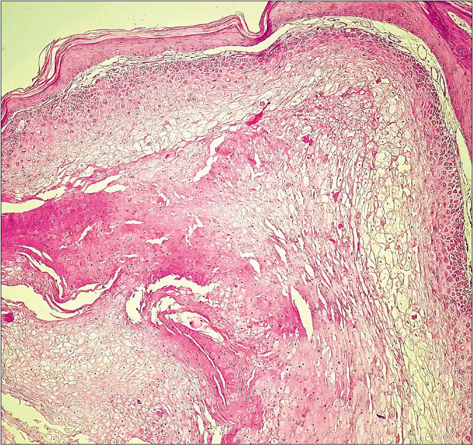 Cutaneous horn-like growth revealing invaginating epithelial lobules of proliferating pale keratinocytes showing trichilemmal keratinization and lacking granular layer. (hematoxylin and eosin, ×100)