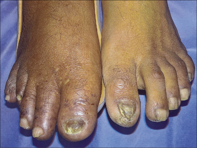 Toes of the right foot are swollen and show erythrocyanotic discoloration with overlying retiform purpura. Note the orthosis supporting right foot and leg. Toes of the left foot are unaffected