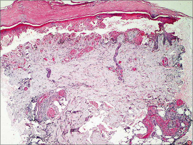 Histopathology shows a subepidermal split with necrosis of overlying epidermis. Dermis shows mild perivascular and peri-eccrine lymphocytic infiltrate, and fibrin thrombi in the lumen of blood vessels in superficial and deep dermis (H and E, 40×)