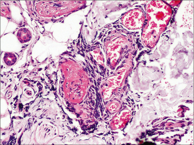 Higher magnification showing fibrin thrombi occluding the blood vessel wall lumen in deep dermis and a perivascular cuffing by lymphocytes (H and E, 400×)