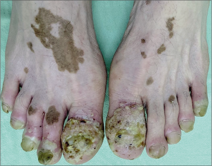 Erythematous crusted verrucous plaques with multiple pustules on the distal phalanges of both great toes associated with nail destruction. Other toes showing bright red erythema with multiple isolated to confluent studded pustules