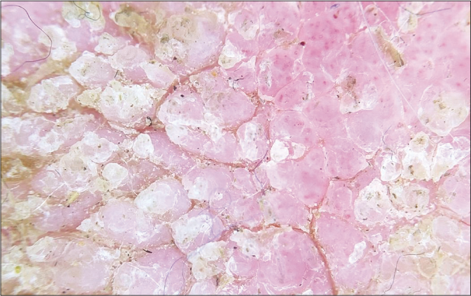 Verrucous excrescences on dermoscopy with Dermlite DL 200 Hybrid, polarized mode (×100)