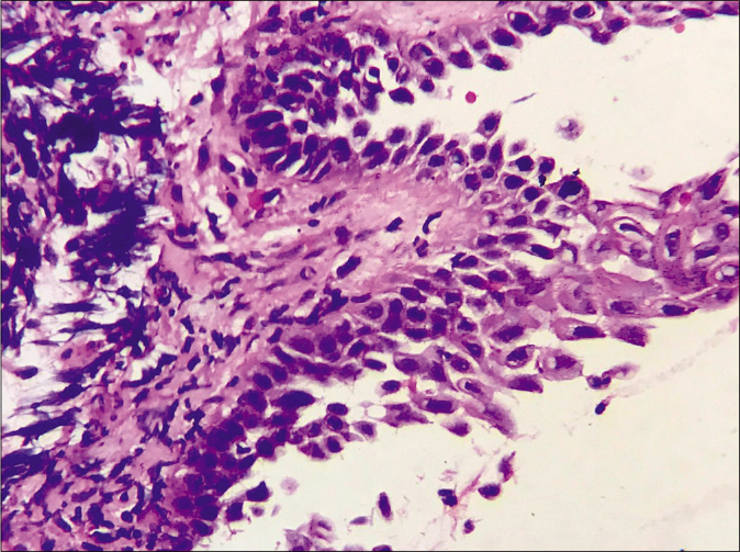 Row of tombstone appearance of basal keratinocytes and multiple acantholytic cells in the blister cavity (H and E, ×400)