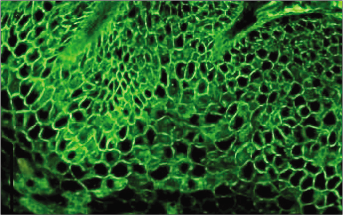 Intercellular deposits of immunoglobulin G on direct immunofluorescence